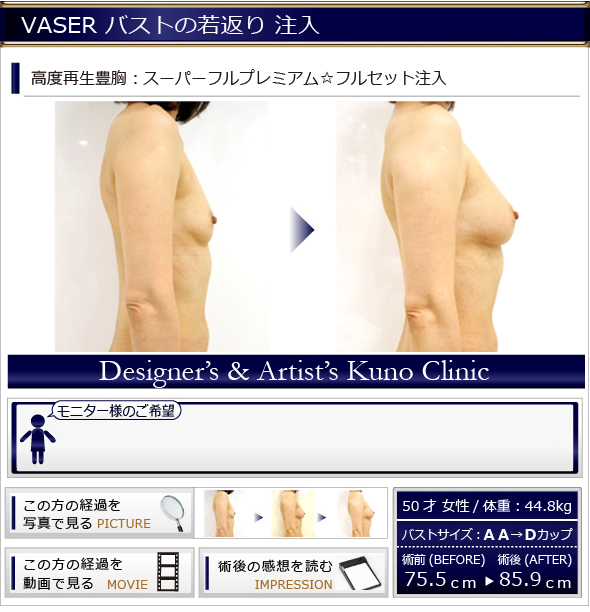 若返り 脂肪&脂肪幹細胞注入 オーダーメイドデザイ高度再生豊胸