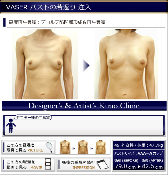 若返り 脂肪&脂肪幹細胞注入 オーダーメイドデザイン高度再生豊胸:デコルテ陥凹部形成&再生豊胸
