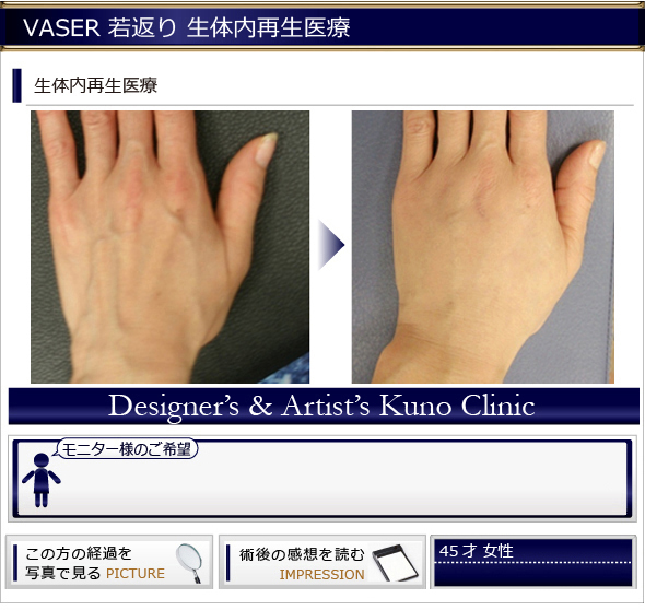 若返り 再生医療 手の甲の若返り