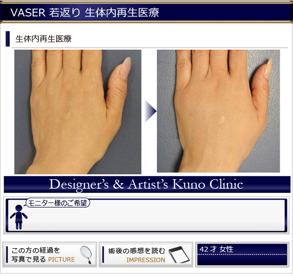 若返り 再生医療 手の甲の若返り