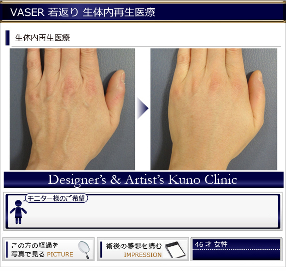 若返り 再生医療 手の甲の若返り