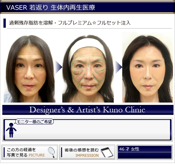 過剰残存脂肪を溶解・全顔面フルプレミアム☆フルセット注入