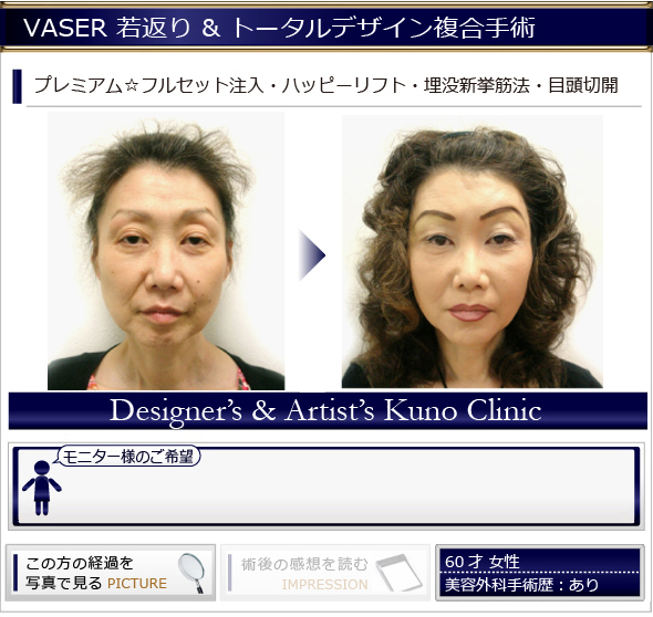 若返り トータルデザイン複合手術 脂肪注入:全顔面プレミアム☆フルセット無制限注入 Happy Lift・上眼瞼タルミ