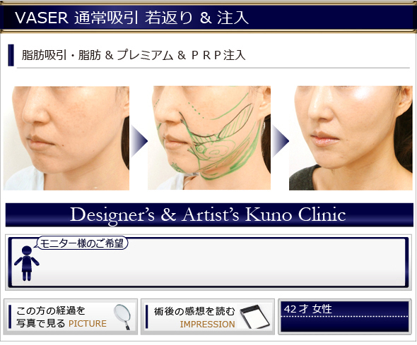 VASER通常吸引 若返り&注入