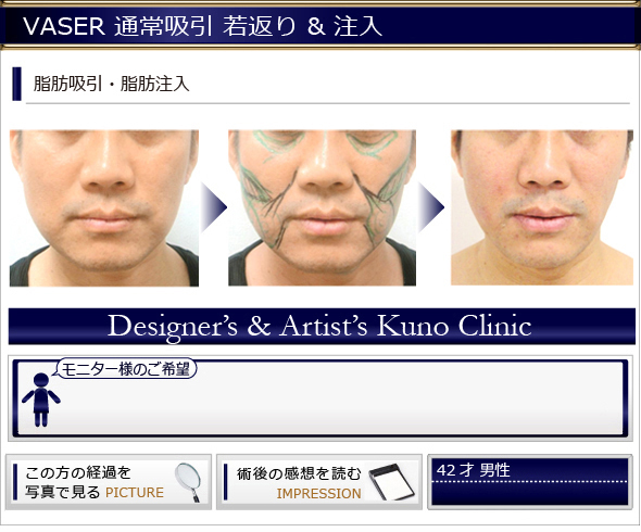 VASER通常吸引 若返り&注入