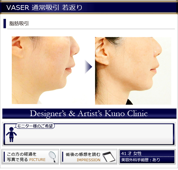VASER通常吸引:頬?下顎 若返り