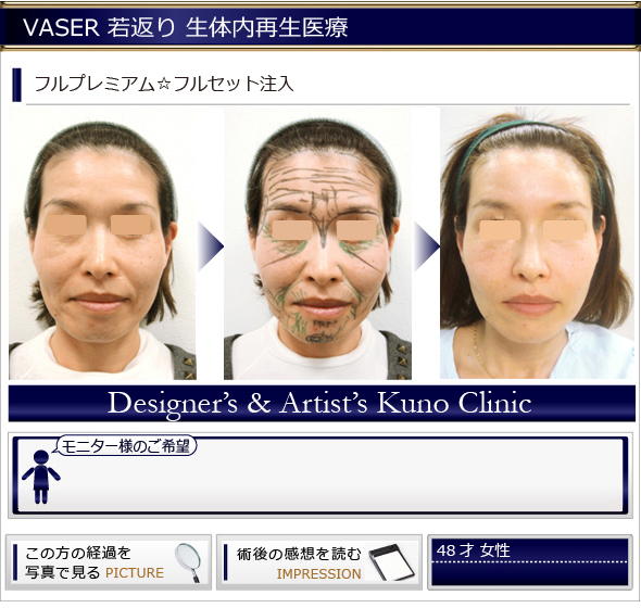 若返り 生体内再生医療