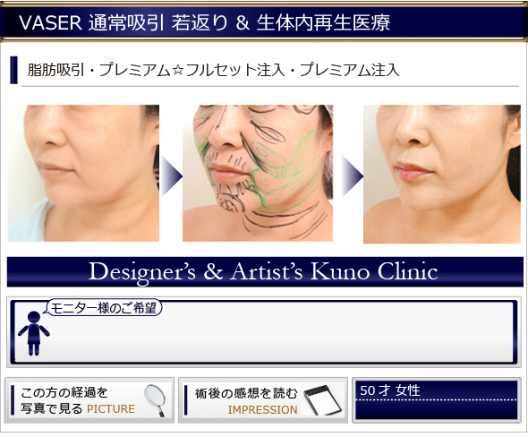 VASER通常吸引 若返り&生体内再生医療