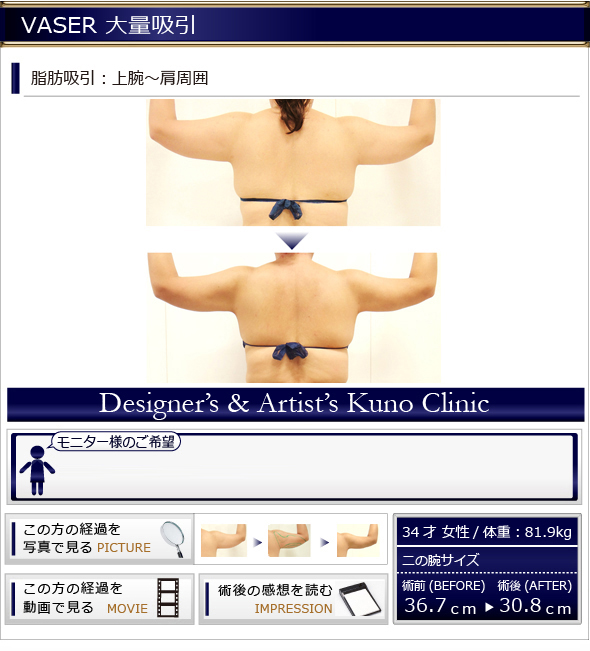 VASER 通常吸引 脂肪吸引:上腕?肩周囲