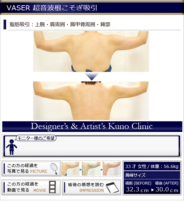 VASER 通常吸引 脂肪吸引:上腕・肩周囲・肩甲骨周囲・背部