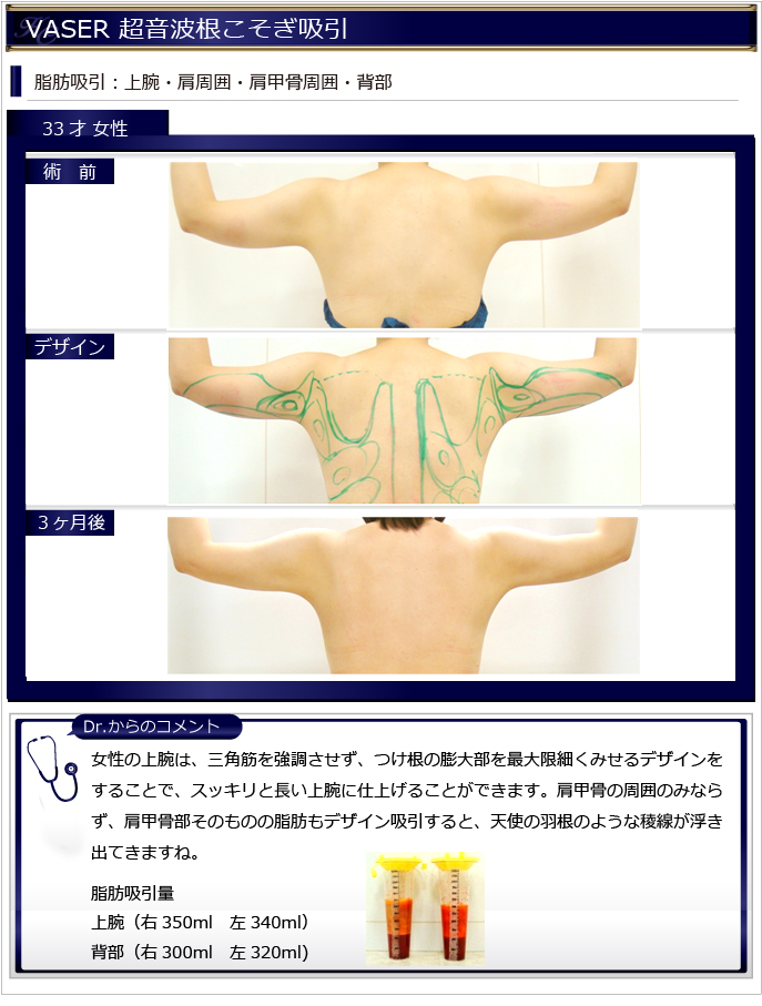 女性脂肪吸引 上腕 二の腕 背部 美容整形 Kunoクリニック 女性脂肪吸引 上腕 二の腕 背部 美容整形 Kunoクリニック