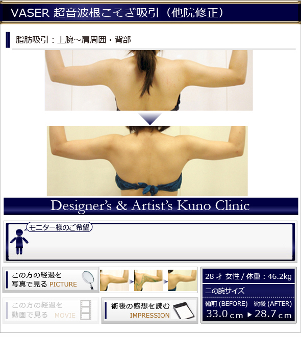 VASER 超音波根こそぎ吸引(他院修正)脂肪吸引:上腕?肩周囲・背部