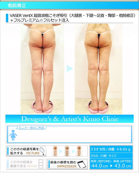 VASER VentX 超音波根こそぎ吸引:大腿表・下腿〜足首・臀部・他院修正