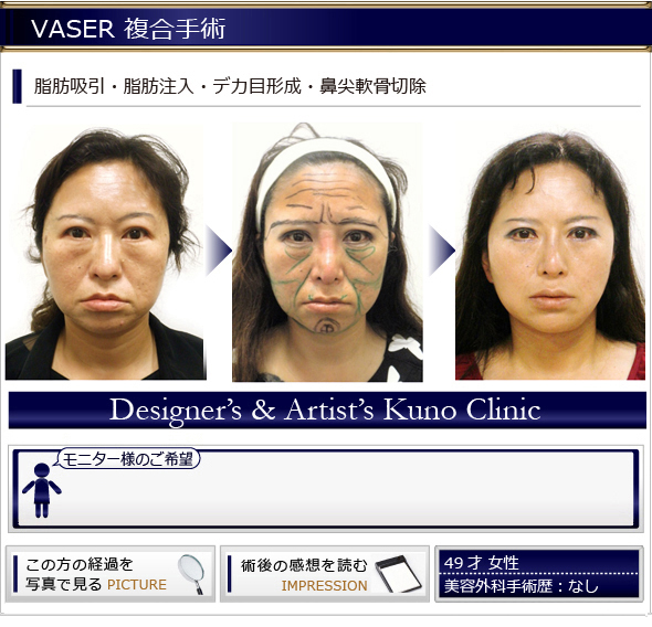 VASER脂肪吸引・脂肪注入・デカ目形成LEVEL4・鼻尖軟骨切除