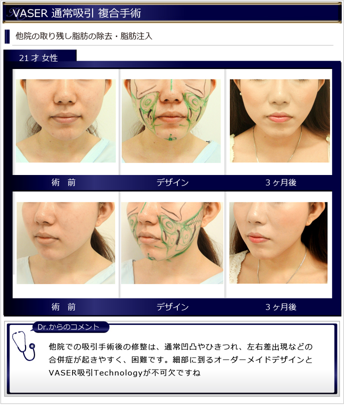 VASER脂肪吸引と別施術を併せた複合手術で、より高い効果を実現