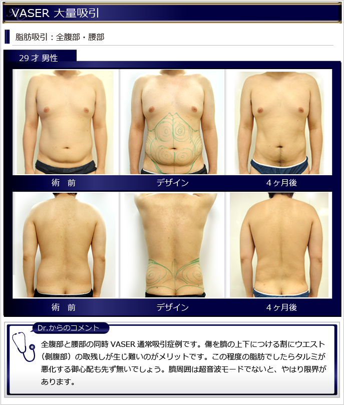 男性脂肪吸引症例 Vaser脂肪吸引美容外科kunoクリニック 大阪 東京 男性脂肪吸引症例 Vaser脂肪吸引美容外科kunoクリニック 大阪 東京