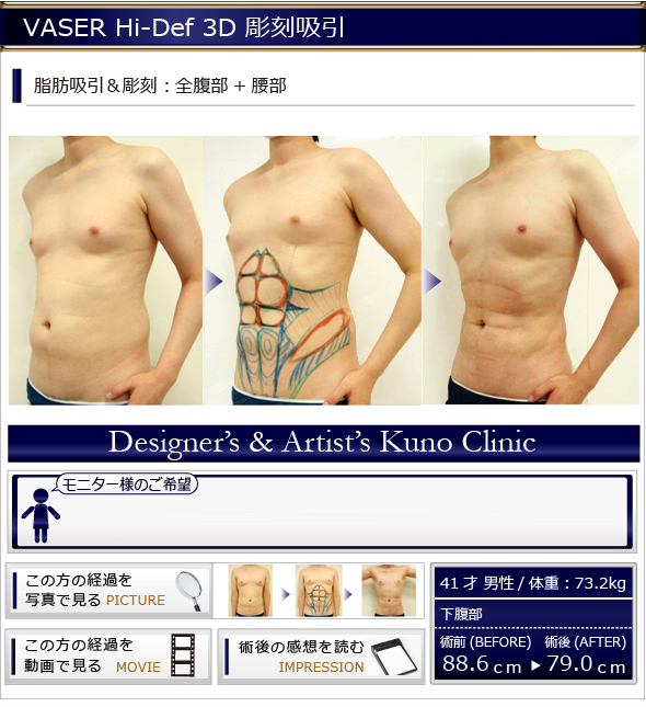 VASER彫刻吸引　脂肪吸引＆彫刻：全腹部＋大胸筋周囲（助骨上部+側胸部）＋腰部