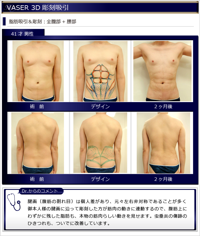 男性脂肪吸引症例 Vaser脂肪吸引美容外科kunoクリニック 大阪 東京