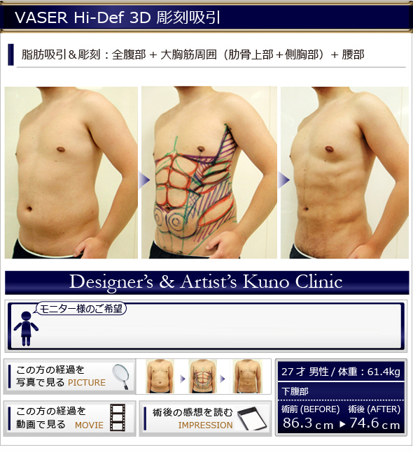 VASER彫刻吸引　脂肪吸引＆彫刻：全腹部＋大胸筋周囲（助骨上部+側胸部）＋腰部