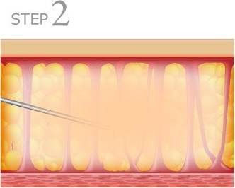 STEP2 牺bwtŖ