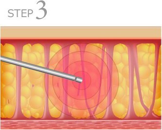 STEP3 牺bwtŖ