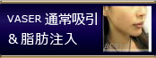 VASER 通常吸引&脂肪注入