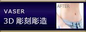 VASER 彫刻吸引