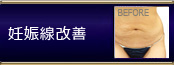 オリジナル施術 妊娠線改善