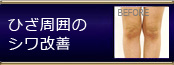 オリジナル施術 ひざ周囲のシワ改善