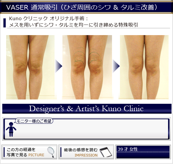 VASER通常吸引　ひざ周囲のシワ＆タルミ改善
