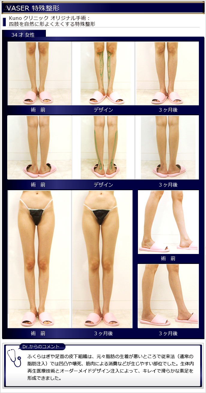 脂肪吸引 オリジナル施術 美容整形 Kunoクリニック 脂肪吸引 オリジナル施術 美容整形 Kunoクリニック