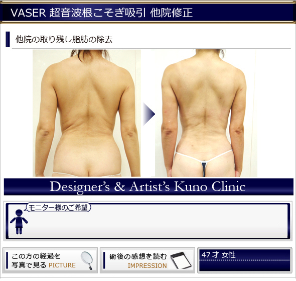 他院の取り残し脂肪の除去：VASER超音波根こそぎ吸引（背部・腰部）