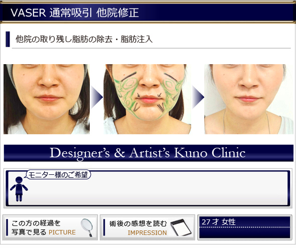 他院脂肪吸引の修正 美容整形 Kunoクリニック