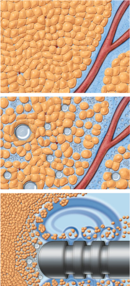 How VASER Ultrasound Works