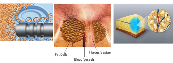 脂肪吸引術　VASER 超音波脂肪吸引システム