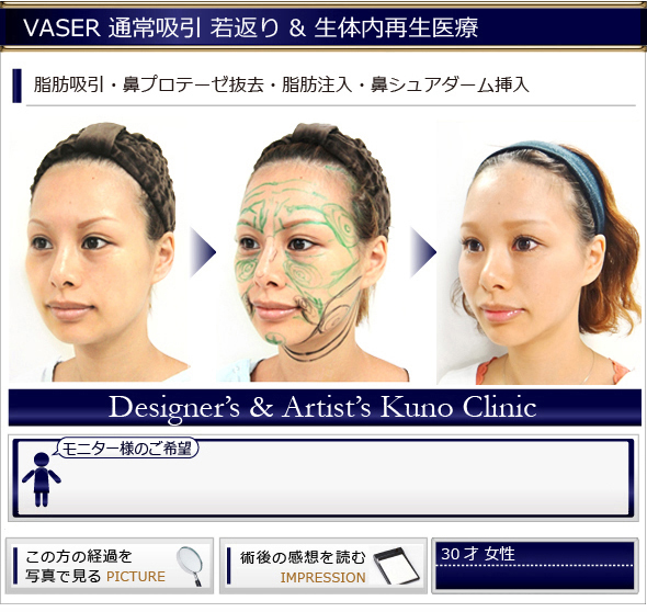 VASER通常吸引　若返り＆生体内再生医療