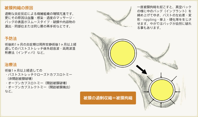 被膜拘縮の原因&予防法&治療法