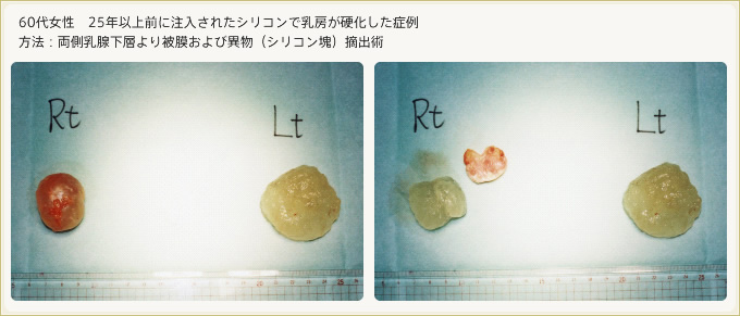 シリコンで乳房が硬化した症例 両側乳腺下層より被膜および異物(シリコン塊)摘出術