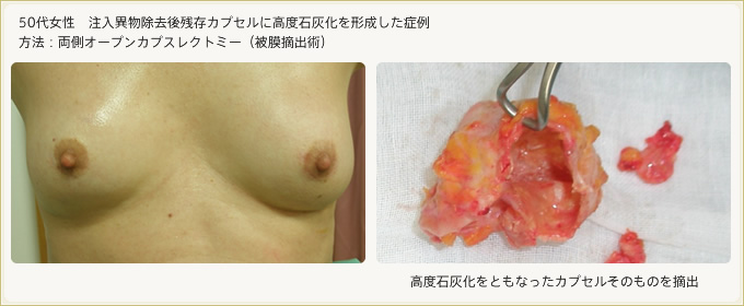注入異物除去後残存カプセルに高度石灰化を形成した症例 両側オープンカプスレクトミー(被膜摘出術)