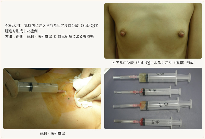 乳腺内に注入されたヒアルロン酸(Sub-Q)で腫瘤を形成した症例 両側穿刺・吸引排出&自己組織による豊胸術