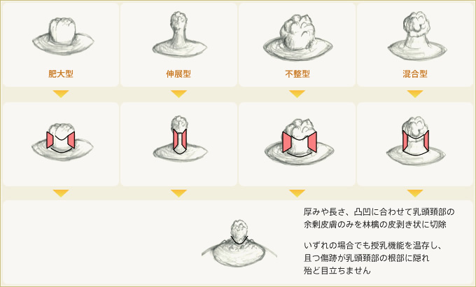 授乳機能を温存し、且つ傷跡が乳頭頚部の根部に隠れ殆ど目立ちません