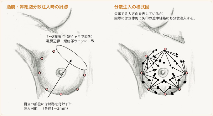 脂肪・幹細胞分散注入時の針跡 分散注入の模式図