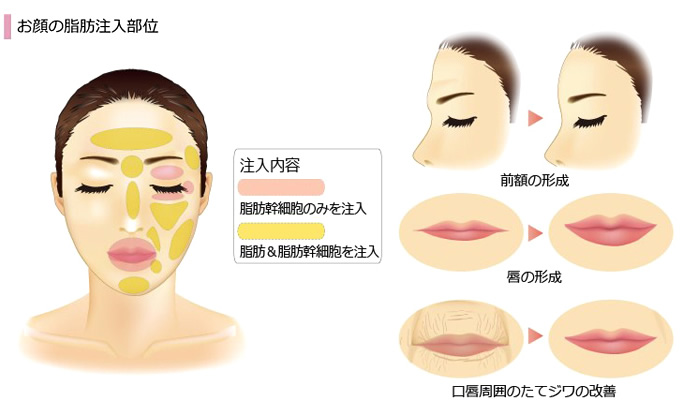 お顔の脂肪注入部位
