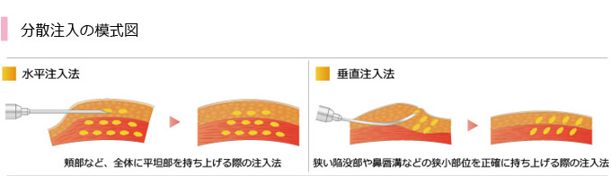 分散注入の模式図