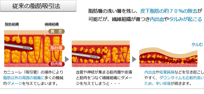 従来の脂肪吸引法