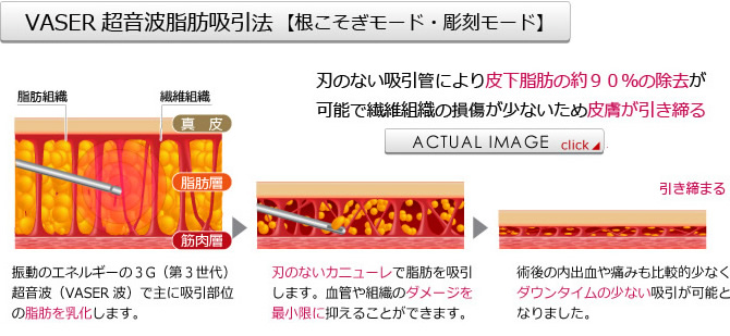 VASER 超音波脂肪吸引法【根こそぎモード・彫刻モード】