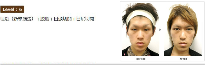 Level:6 埋没(新拳筋法)+脱脂+目尻切開+目頭切開