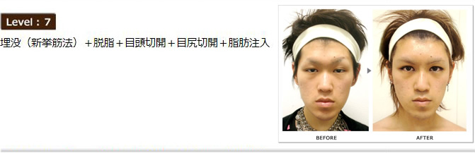 Level:7 埋没(新拳筋法)+脱脂+目尻切開+目頭切開+脂肪注入