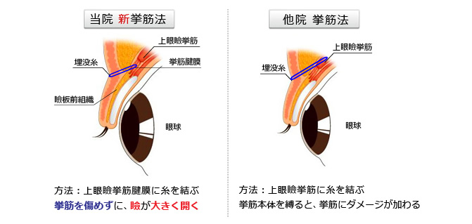 瞼板法・新挙筋法の図