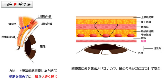 新挙筋法